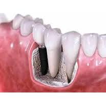 implanturi dentare in Bucuresti