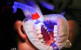infectie implant dentar