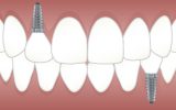 implant dentar in Bucuresti